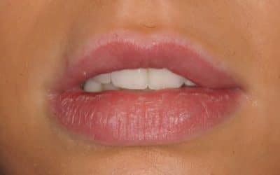 How Long Does Lip Fillers Last: Dentist Explain the Longevity