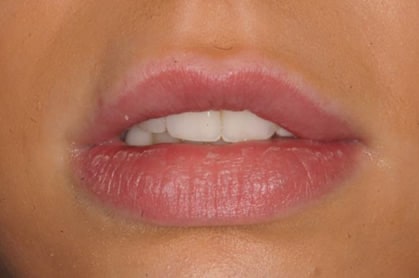 Lip fillers before & after