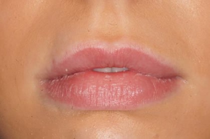 Lip sculpting and defining