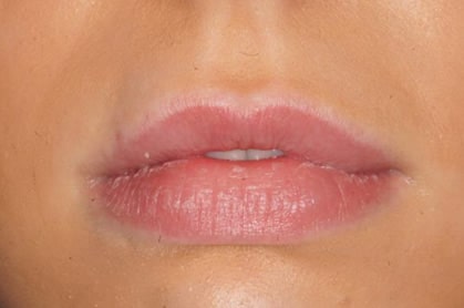 Lip fillers before & after