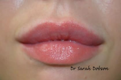 Lip fillers before and after 2
