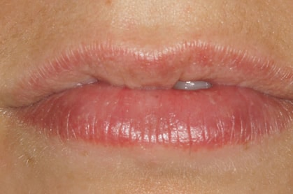Lip filler before and after example