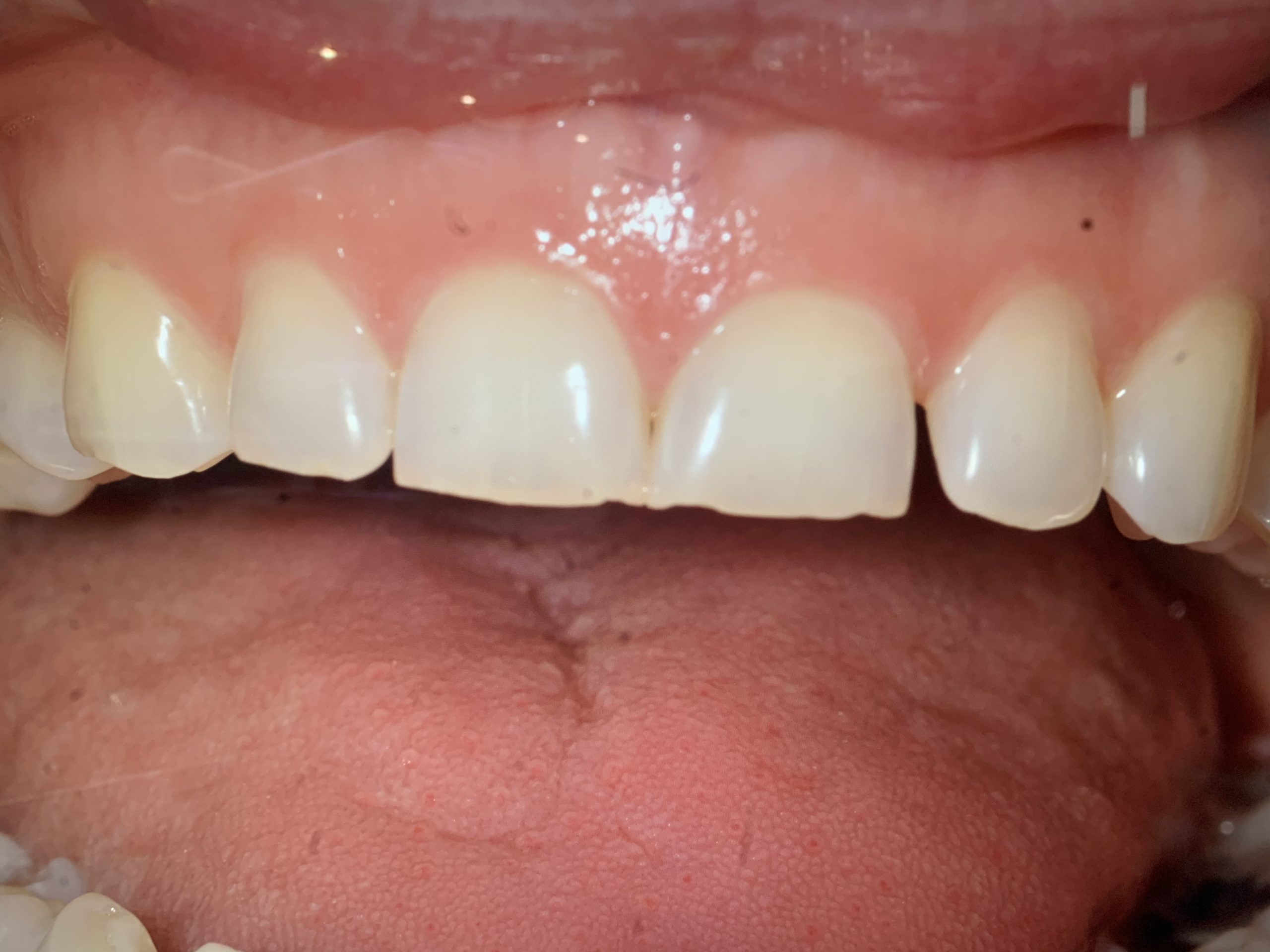 927C3A72-9192-46E5-85C7-32D3B9FA9DEC After the treatment