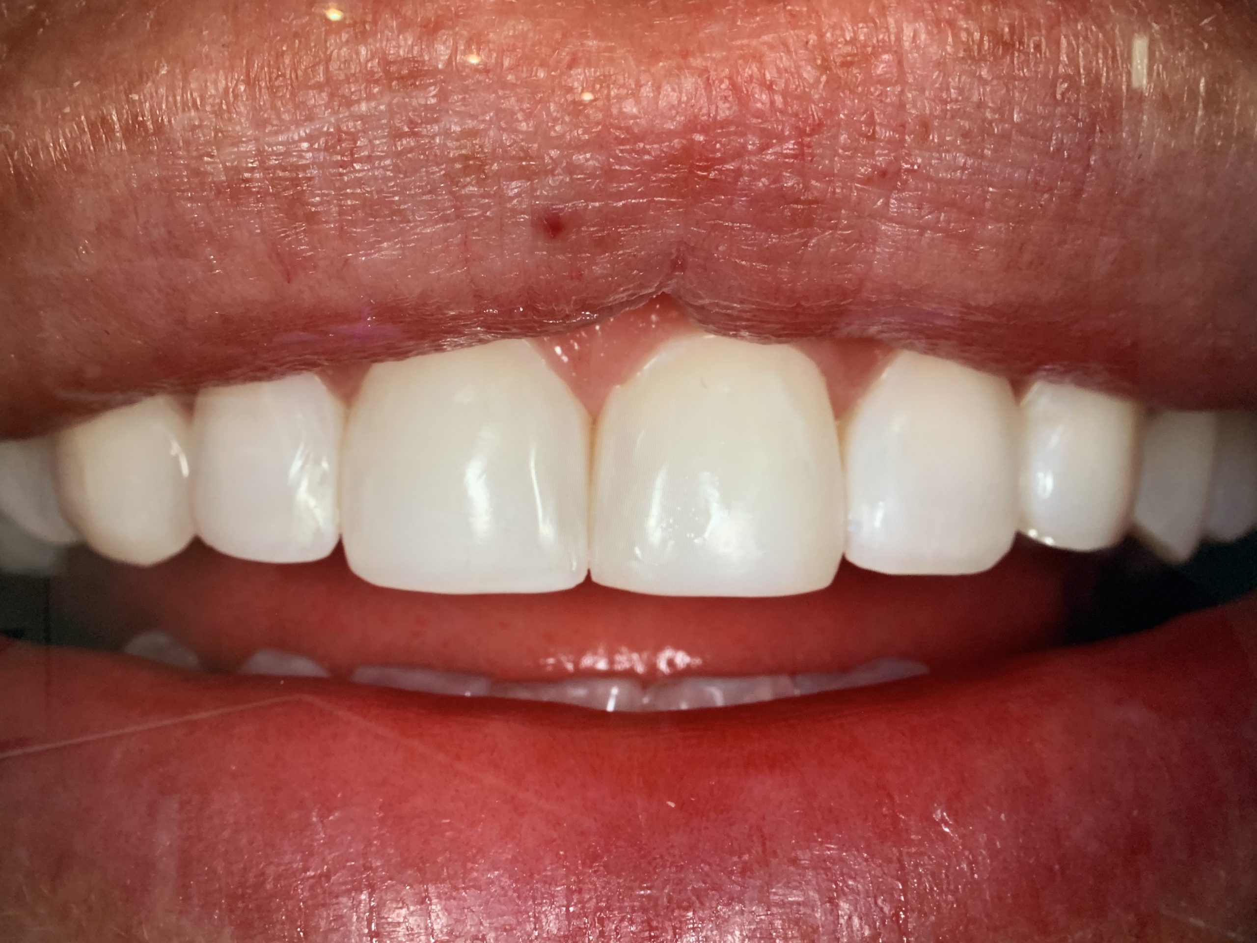 927C3A72-9192-46E5-85C7-32D3B9FA9DEC After the treatment