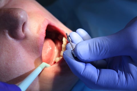 dental implants wigan