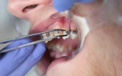 Best Way to Straighten Teeth: Top Teeth Straightening Options