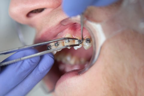 Fixed Adult Braces