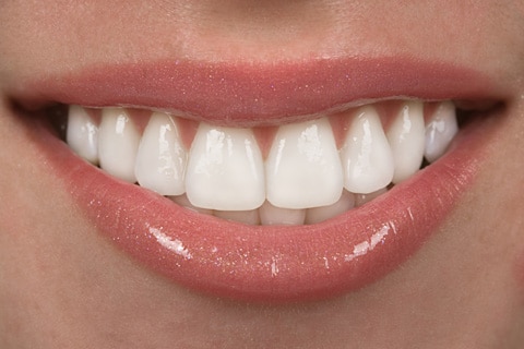 Clear Braces for Adults