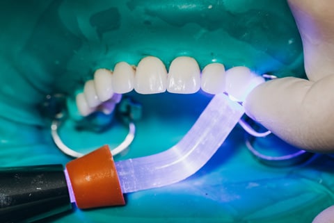 composite-bonding-consult Composite Bonding Treatment