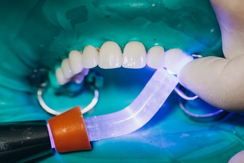 Composite Bonding vs Veneers: Which is Better Treatment?