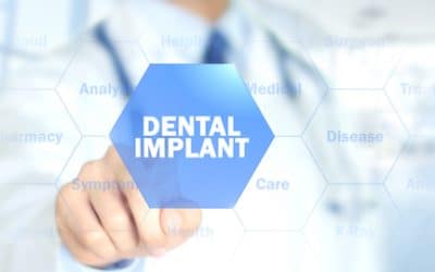 Are Dental Implants Painful? What to Expect?