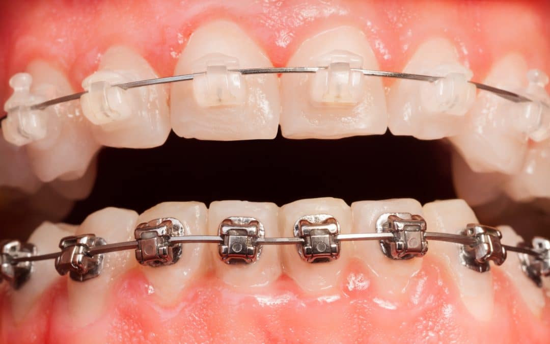 Opened mouth with ceramic and metal braces