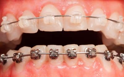 Metal vs Ceramic Braces: Which Option is Best For You?