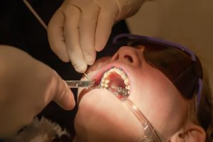 How Long Does Front Teeth Bonding Last?