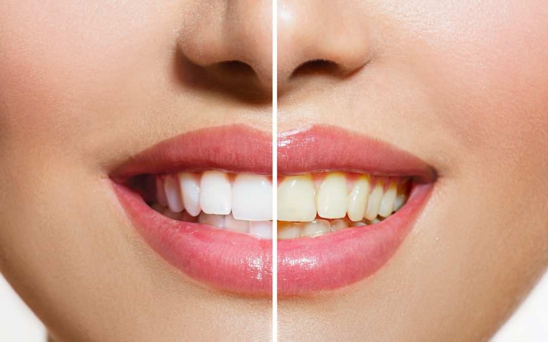 Woman Teeth Before and After Whitening