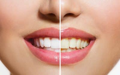 How to Whiten Composite Bonding: Tips from Leading Dentists