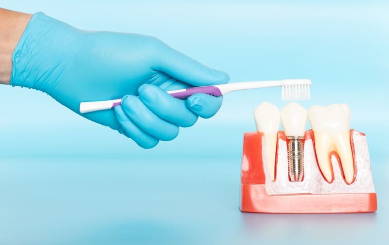 Dental Implants Aftercare