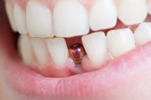 Single tooth implant