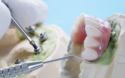 How Long Do Dental Implants Last? A Guide to Implant Longevity