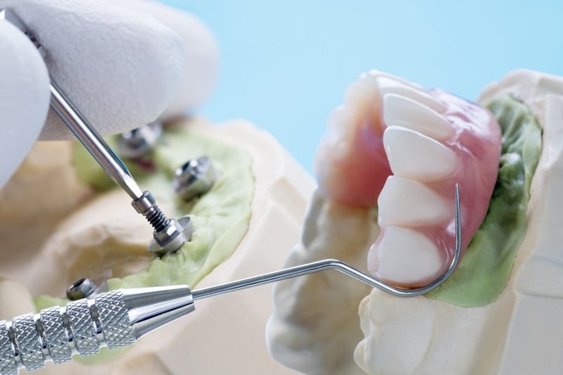 How Long Do Dental Implants Last? A Guide to Implant Longevity