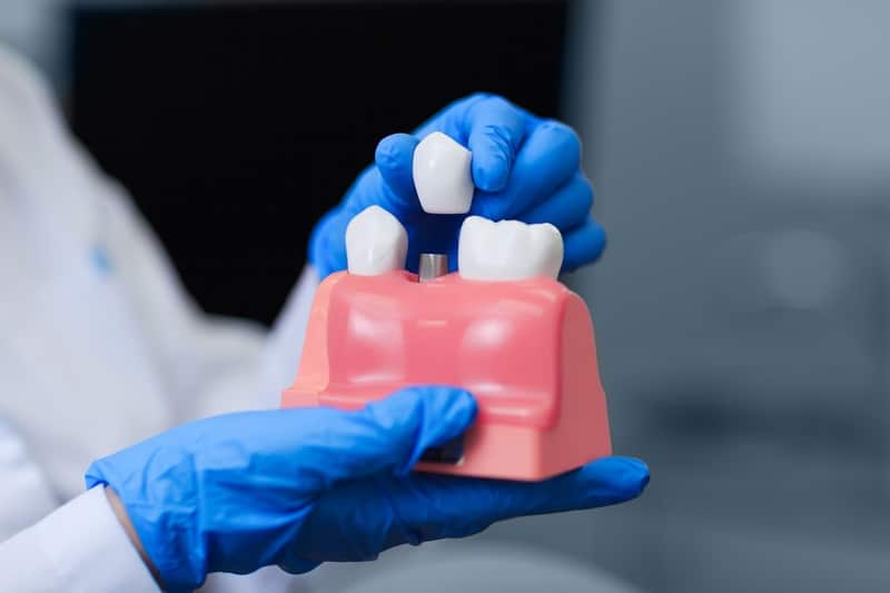 dental implant in hands of doctor
