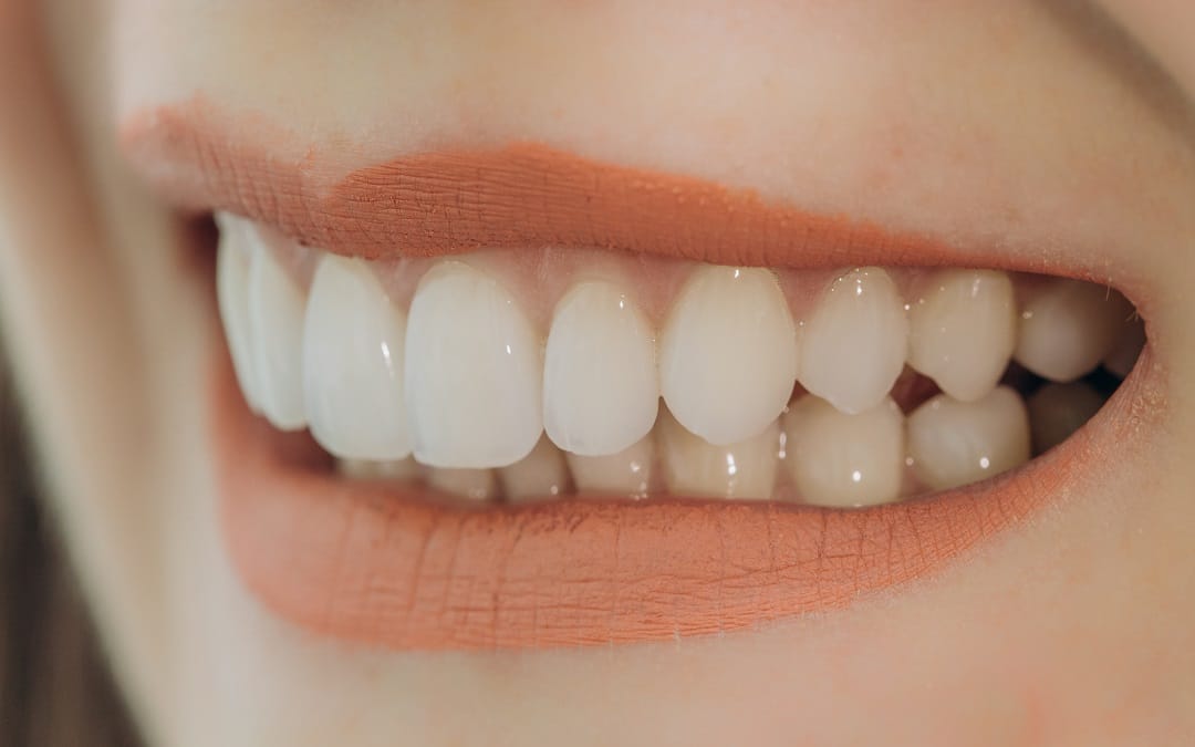 Cost of Porcelain Veneers in the UK