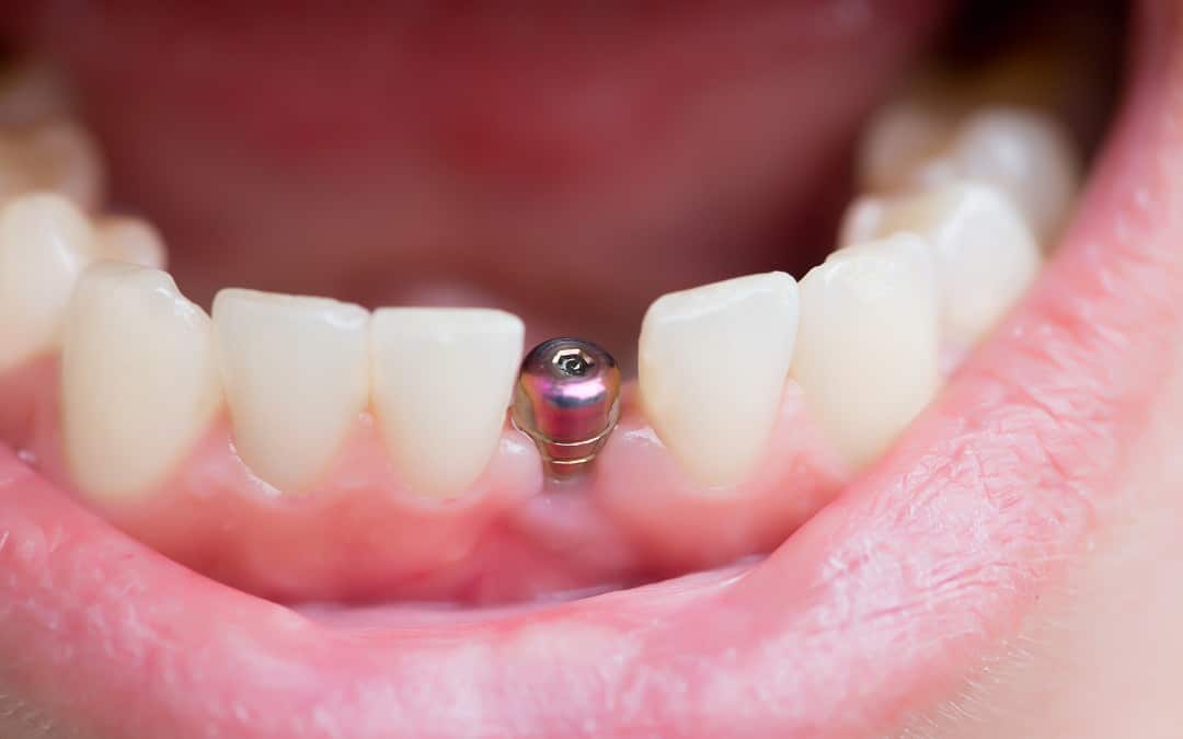 What is a Tooth Implant?