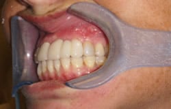 implants-5a