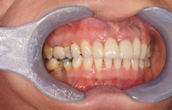 implants-6a