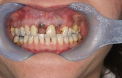 implants-6a