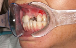 implants-5a