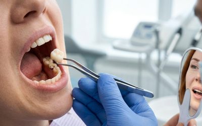 What Is a Tooth Crown and When Do You Need One?